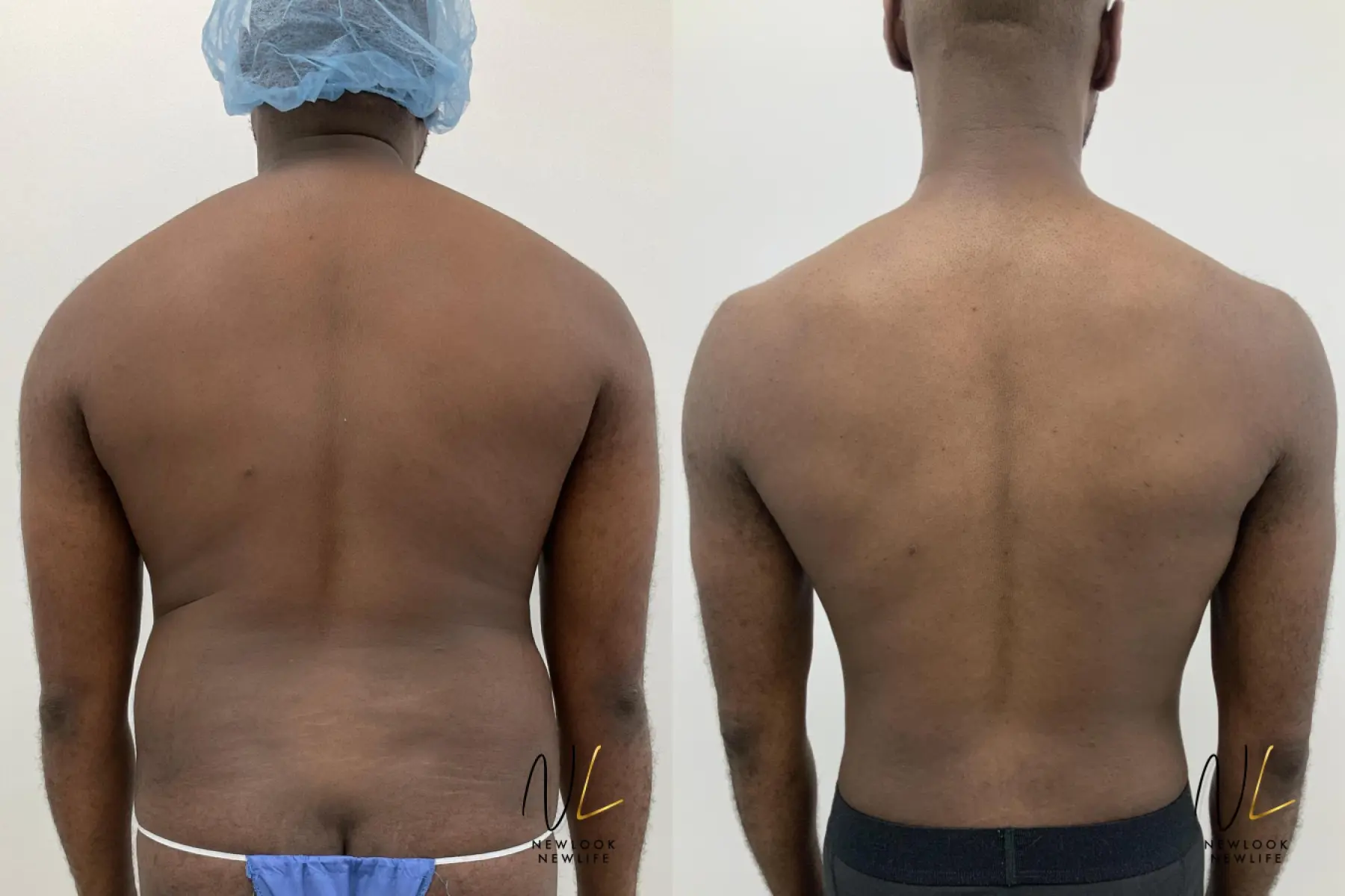 Male Liposuction: Patient 1 - Before and After 4