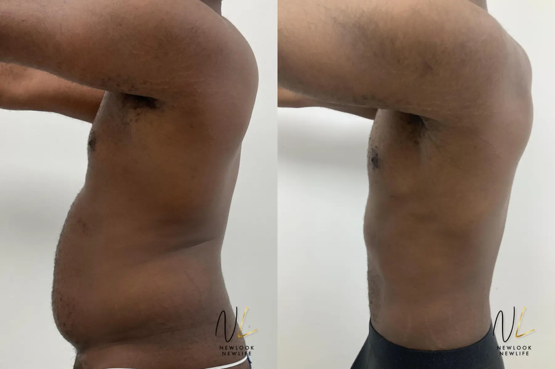 Male Liposuction: Patient 1 - Before and After 5