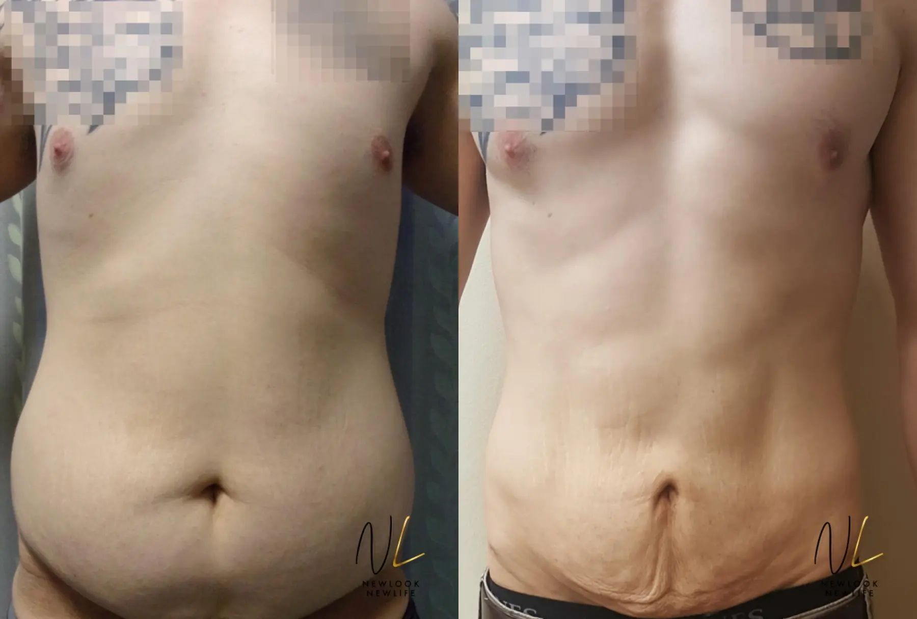 Male Liposuction: Patient 9 - Before and After  