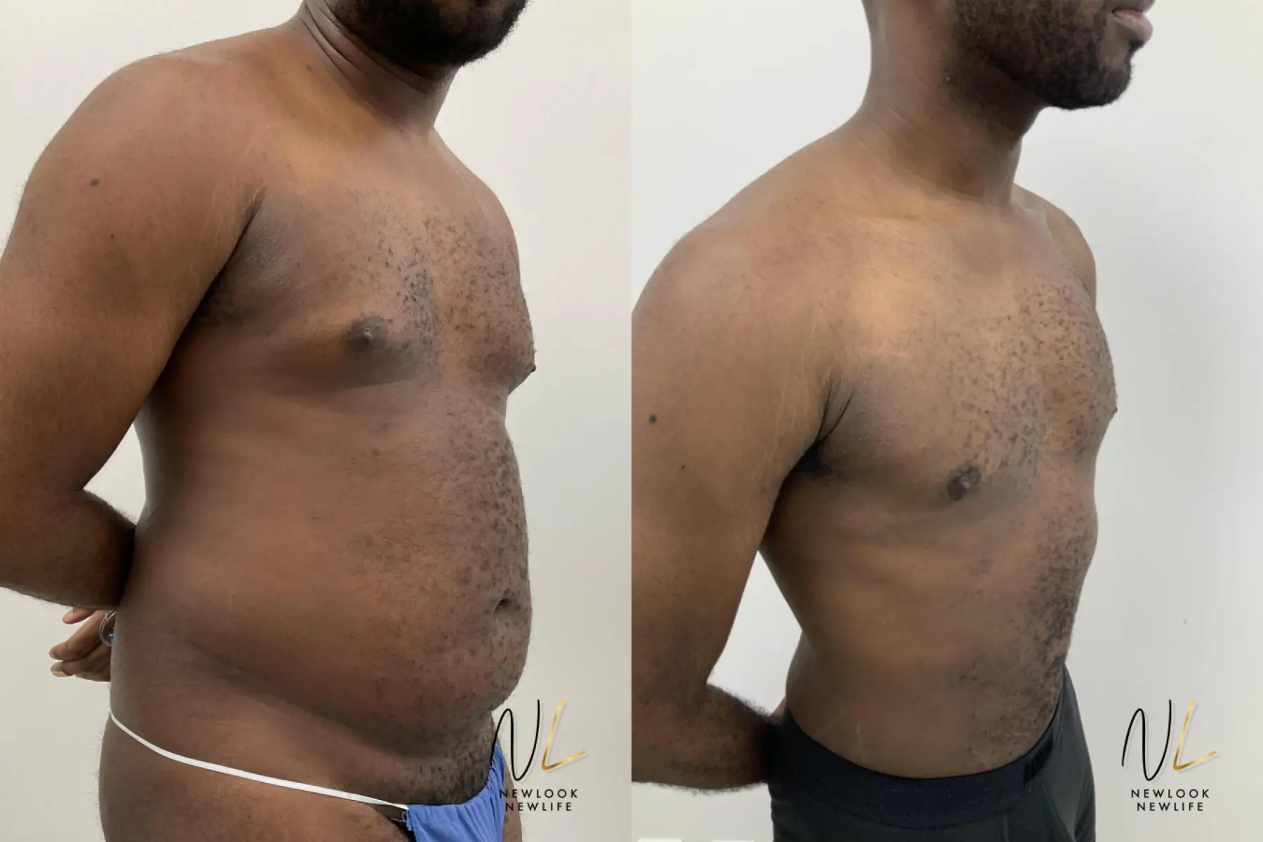 Male Liposuction: Patient 1 - Before and After 7