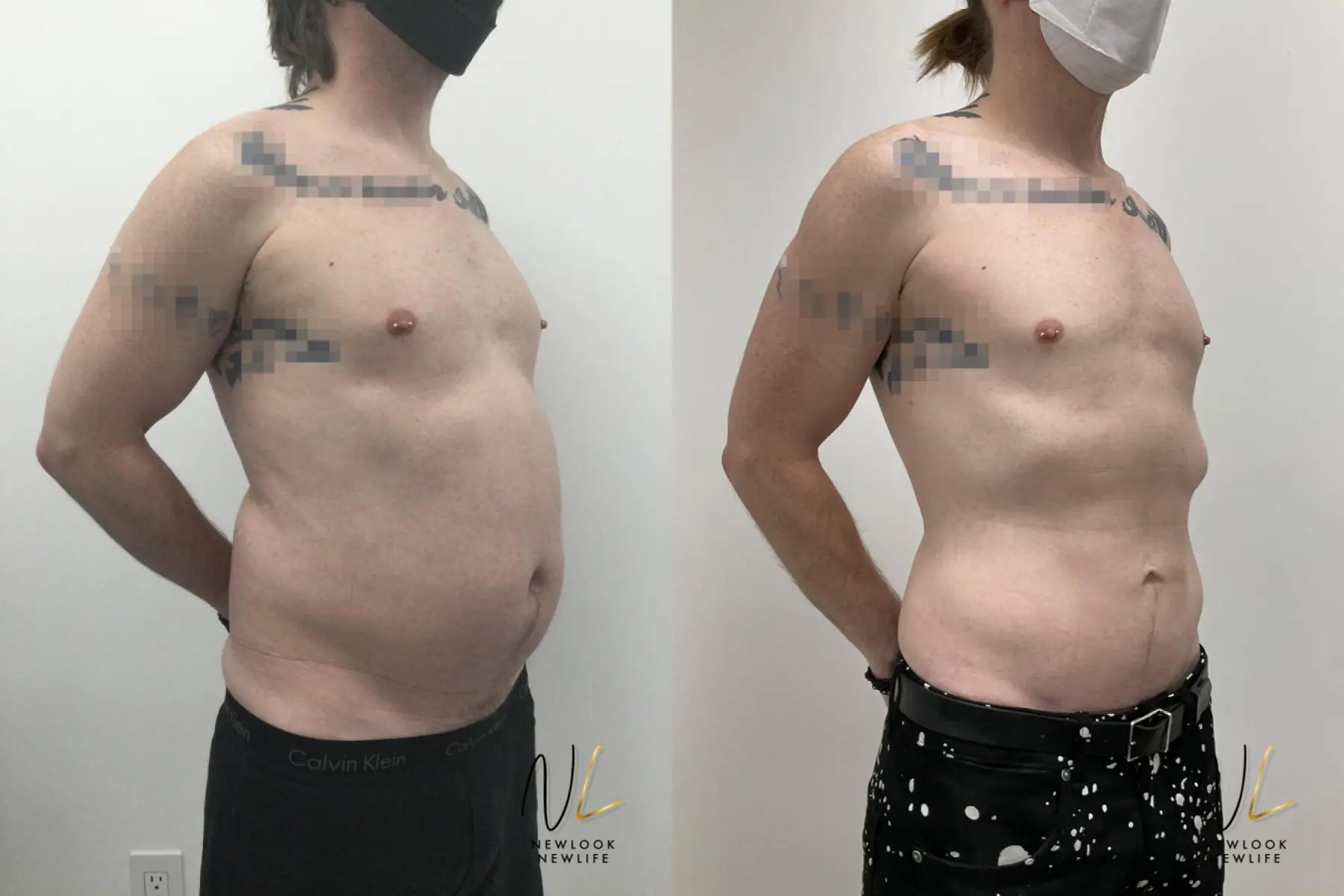 Male Liposuction: Patient 10 - Before and After 2