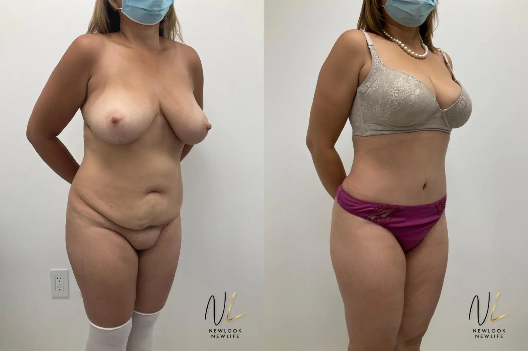 Mommy Makeover: Patient 5 - Before and After  