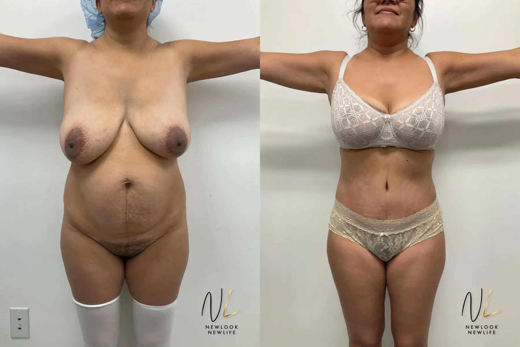 Mommy Makeover: Patient 3 - Before and After  