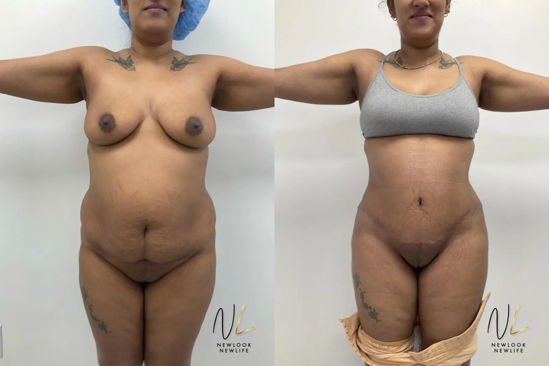 Mommy Makeover: Patient 1 - Before and After  