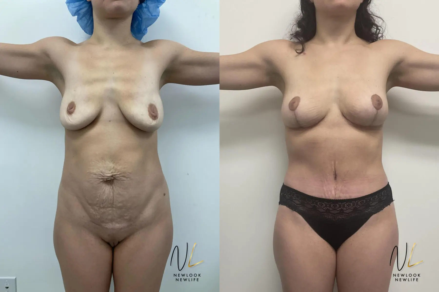 Mommy Makeover: Patient 7 - Before and After 1