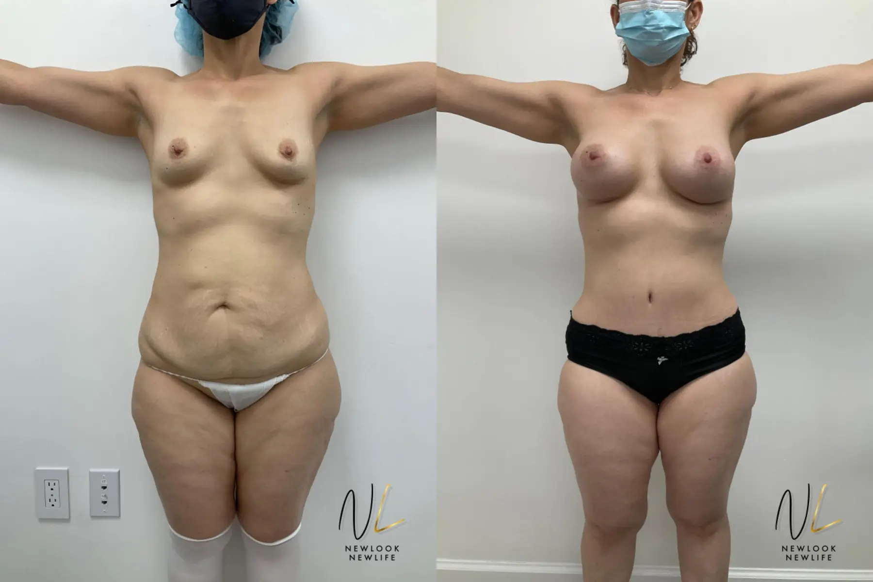 Mommy Makeover: Patient 4 - Before and After 1