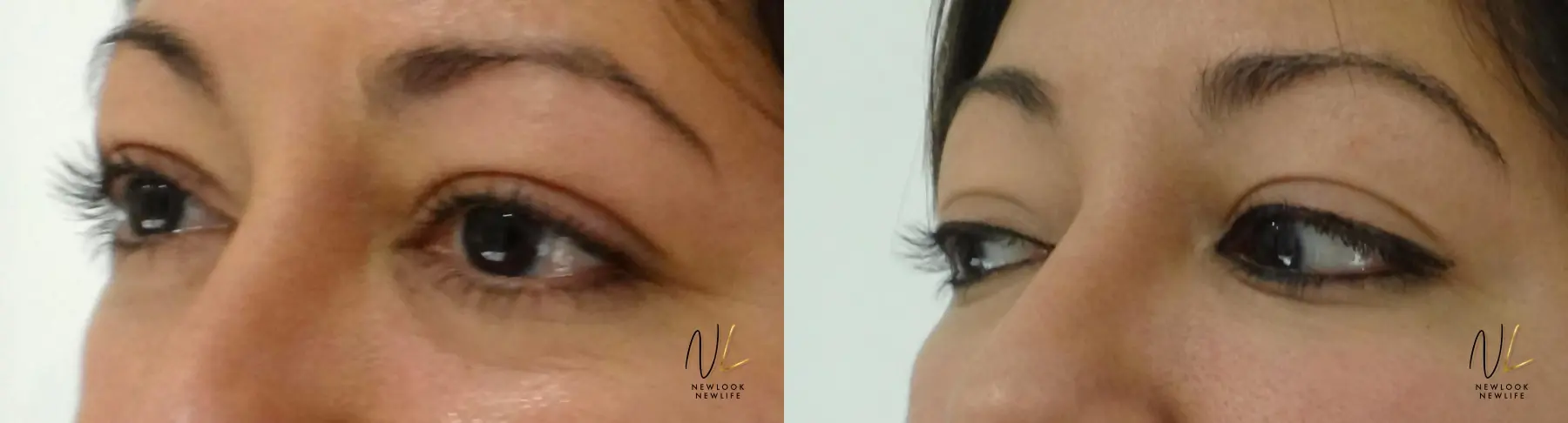 Nasal Contouring: Patient 1 - Before and After 1