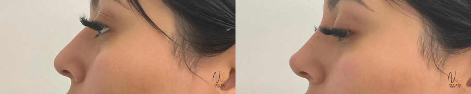 Nasal Contouring: Patient 3 - Before and After  