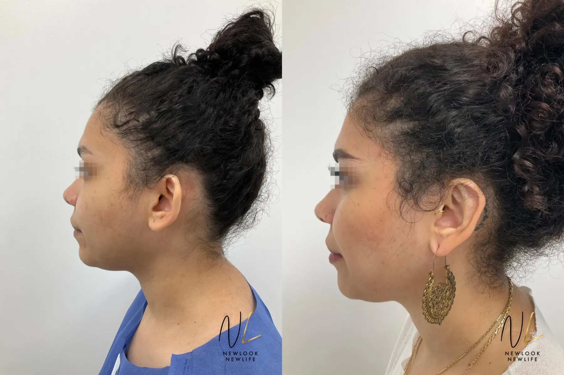 Otoplasty: Patient 11 - Before and After 2