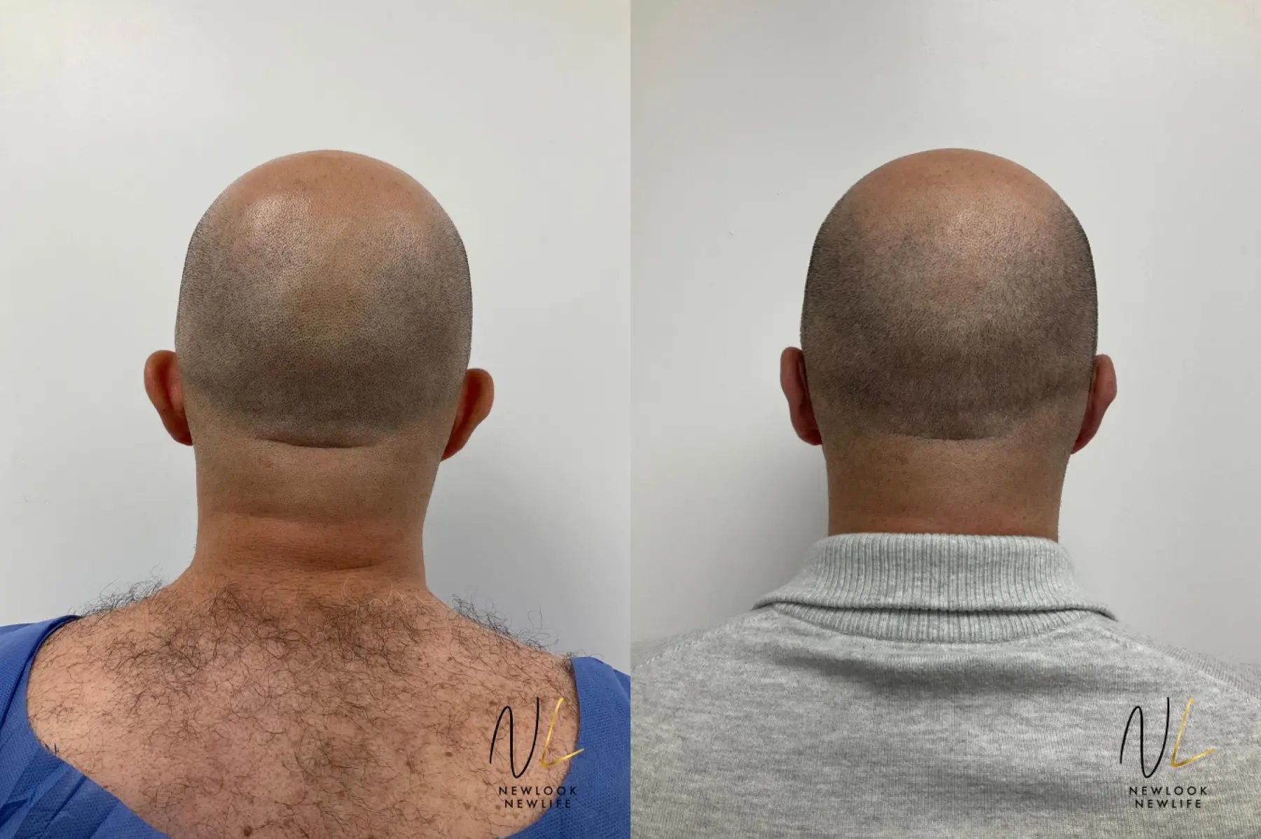 Otoplasty: Patient 10 - Before and After  