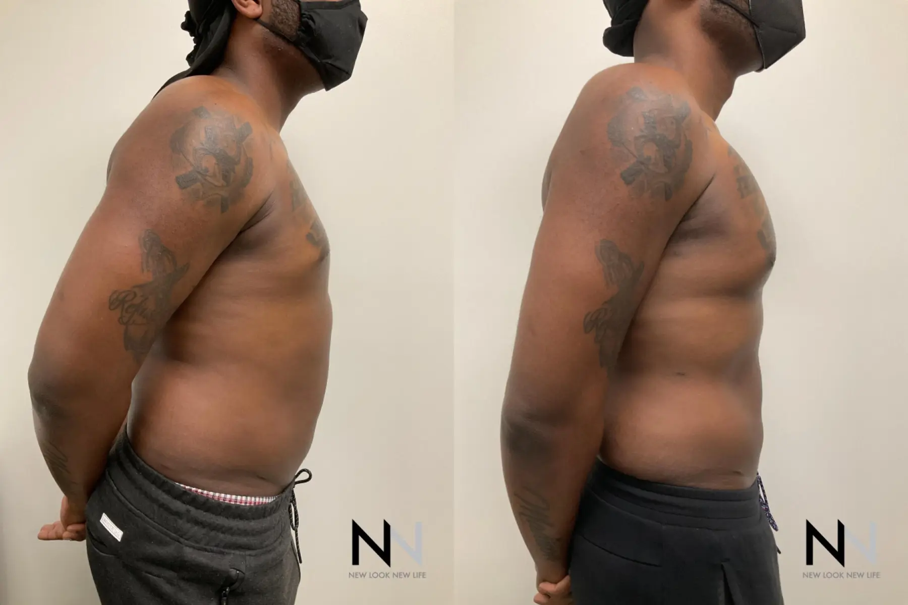 Pec Implants: Patient 1 - Before and After 4