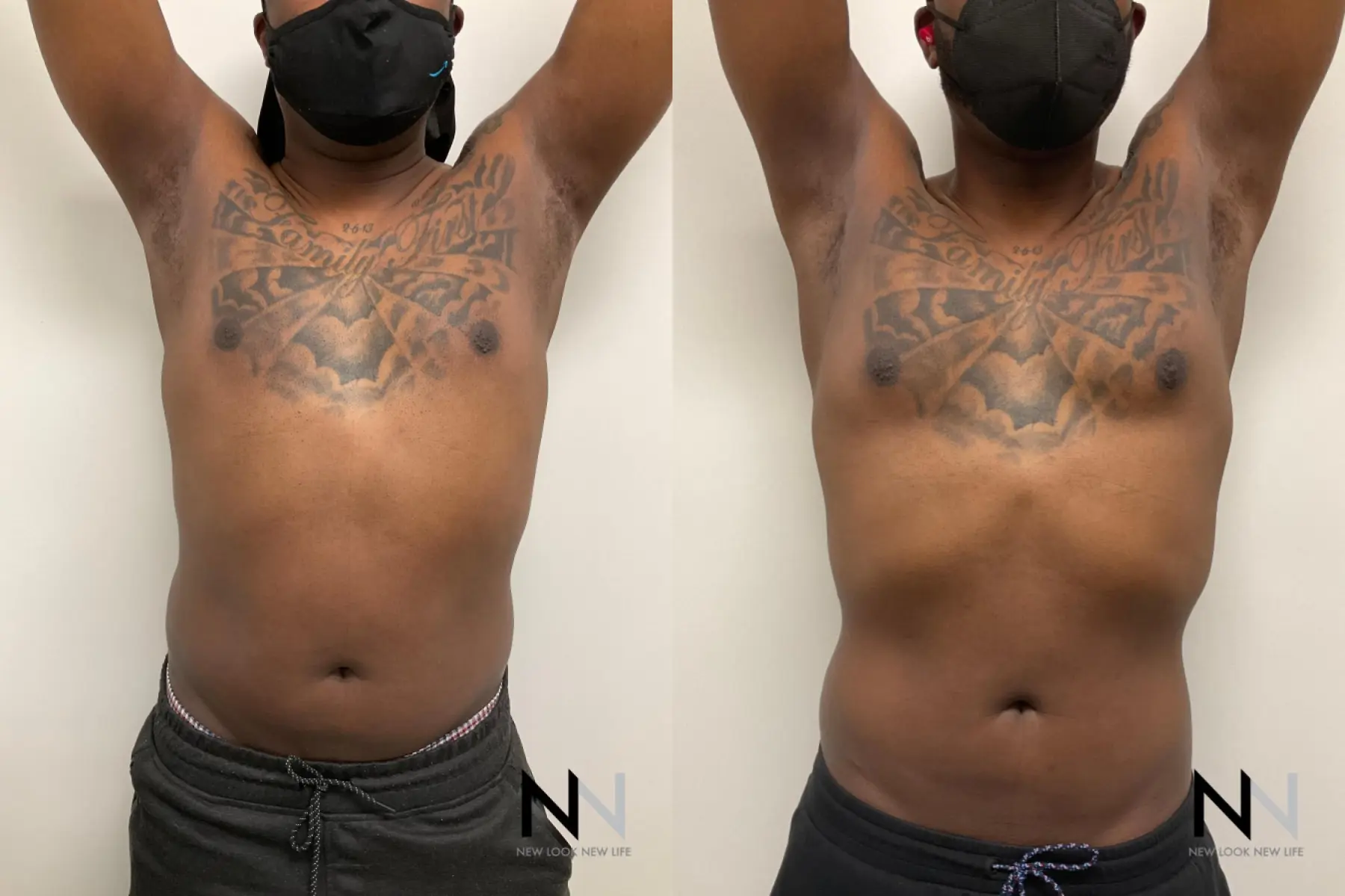 Pec Implants: Patient 1 - Before and After 2