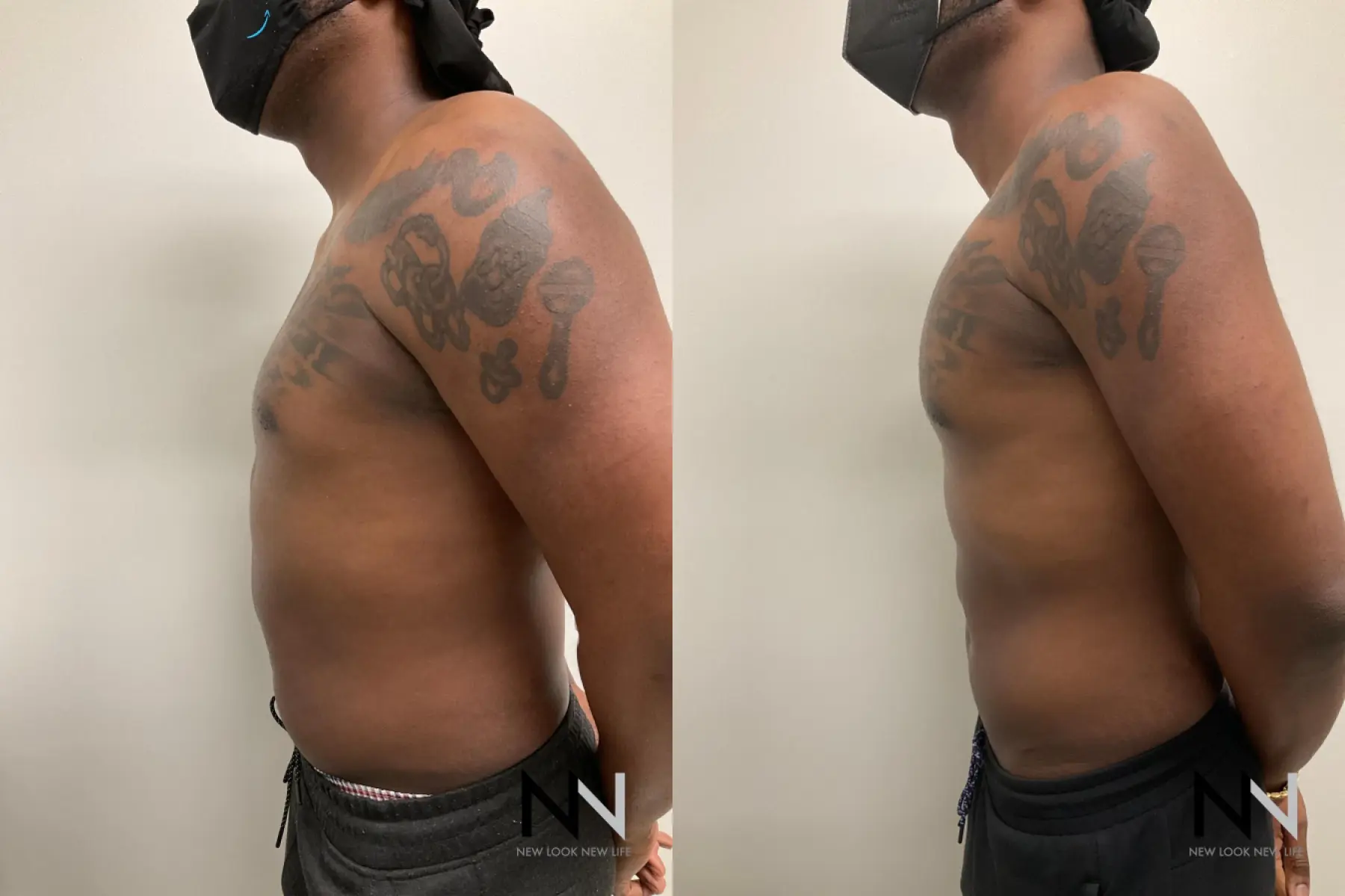 Pec Implants: Patient 1 - Before and After 3