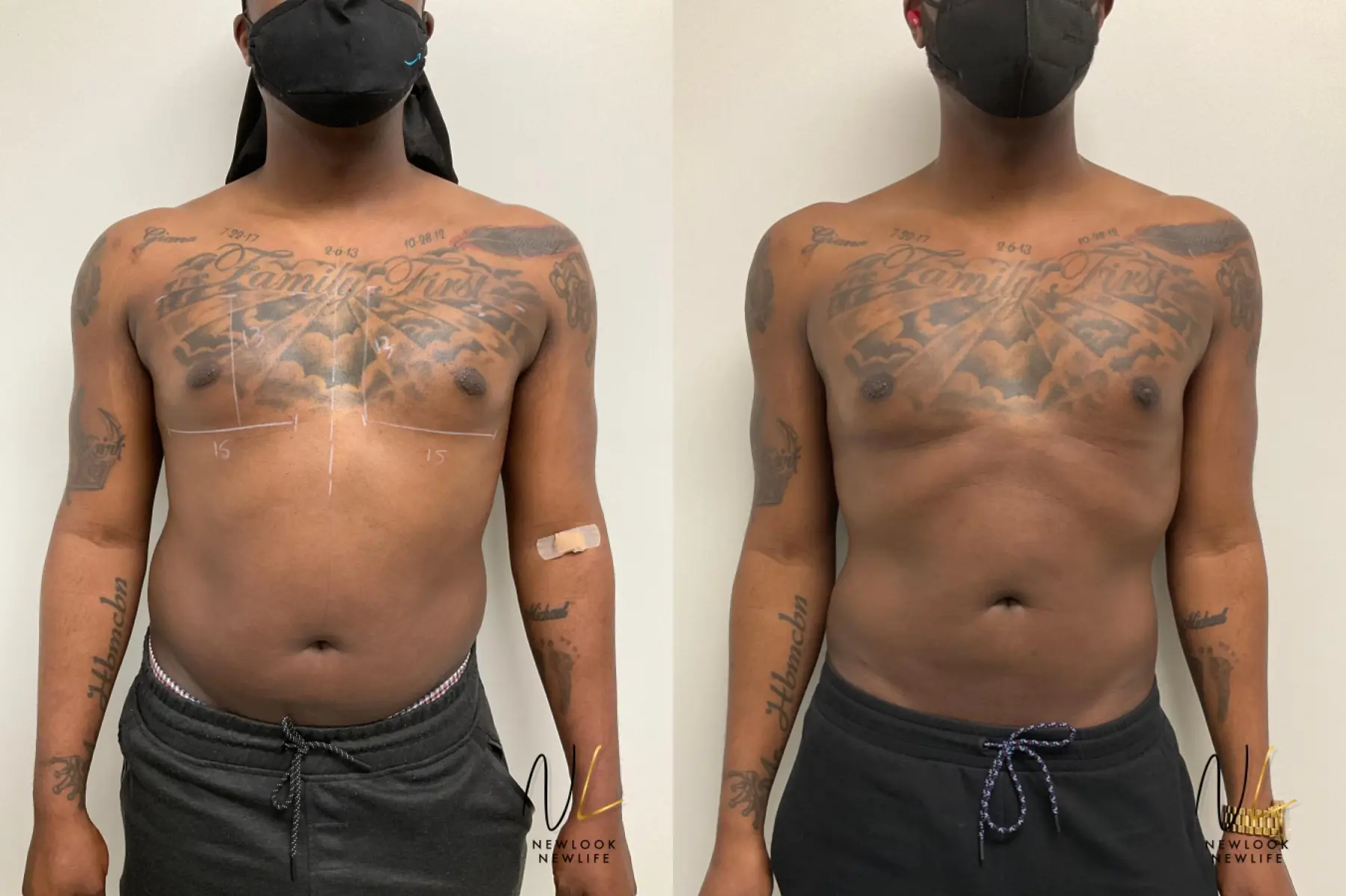 Pec Implants: Patient 1 - Before and After  