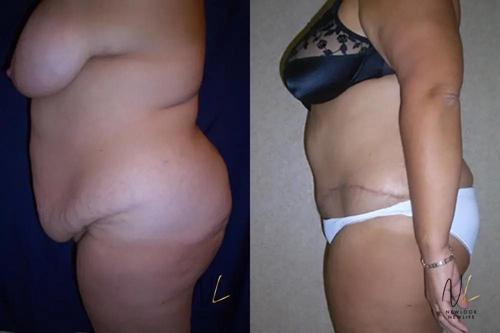 Tummy Tuck: Patient 11 - Before and After 2