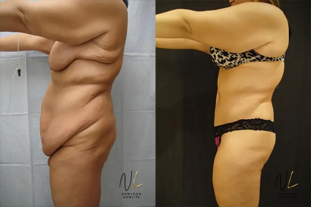 Tummy Tuck: Patient 20 - Before and After 2