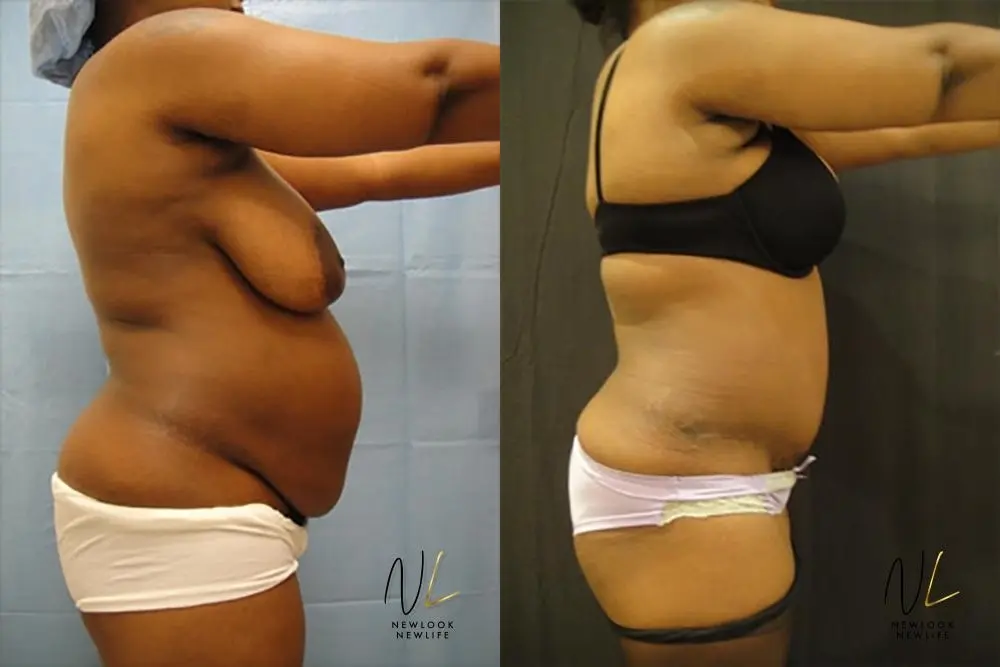 Tummy Tuck: Patient 21 - Before and After 3