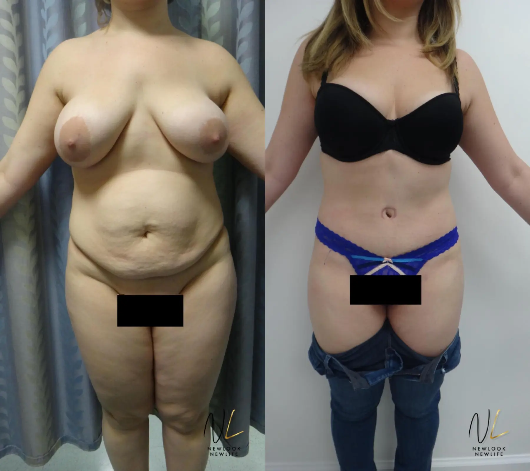 Tummy Tuck: Patient 26 - Before and After 1