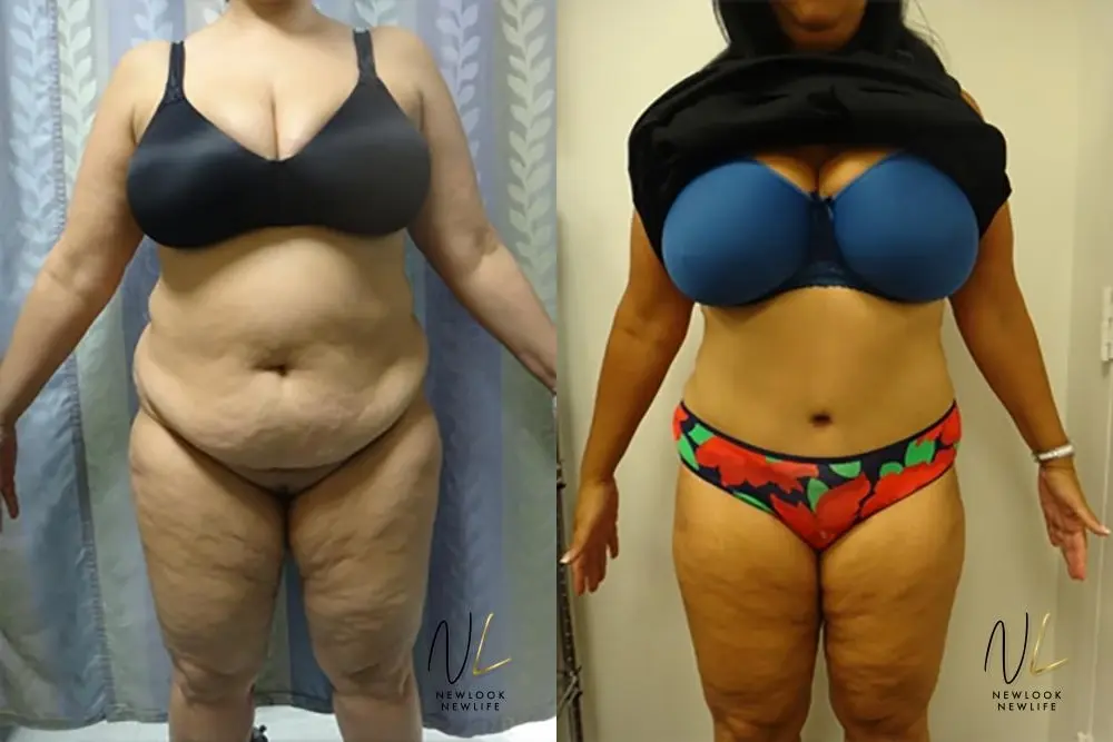 Tummy Tuck: Patient 18 - Before and After 1