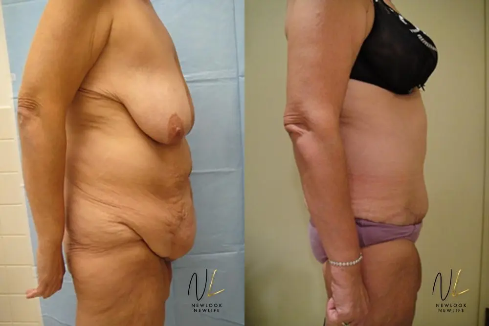 Tummy Tuck: Patient 10 - Before and After 3