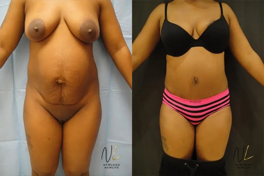 Tummy Tuck: Patient 14 - Before and After 1