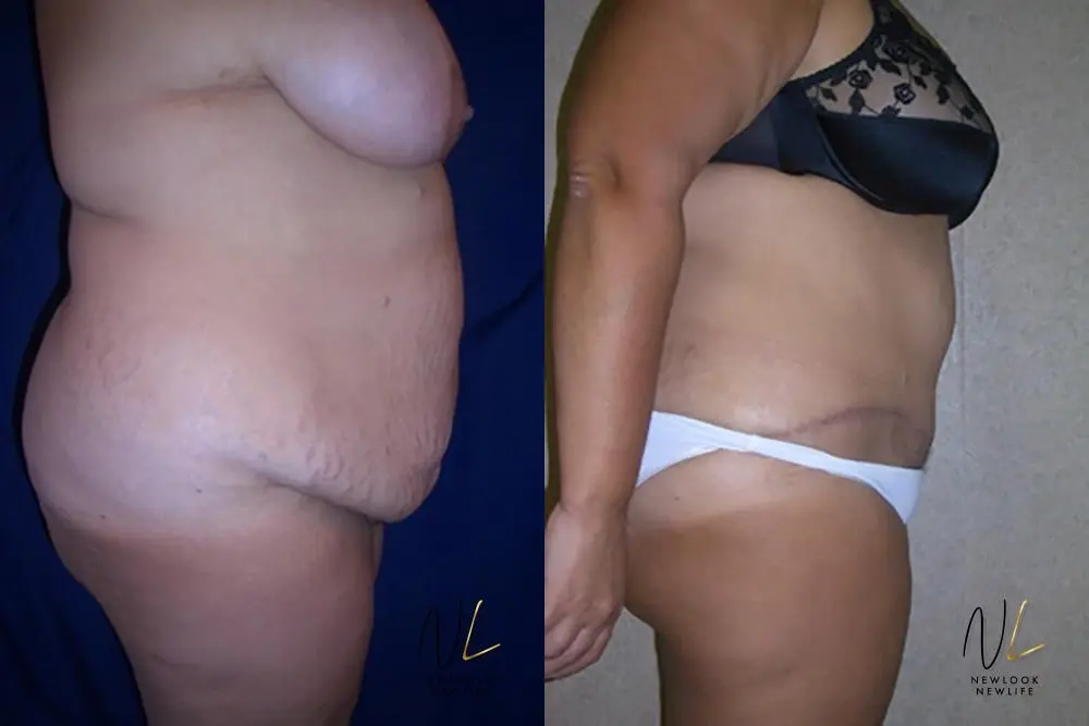 Tummy Tuck: Patient 11 - Before and After 3