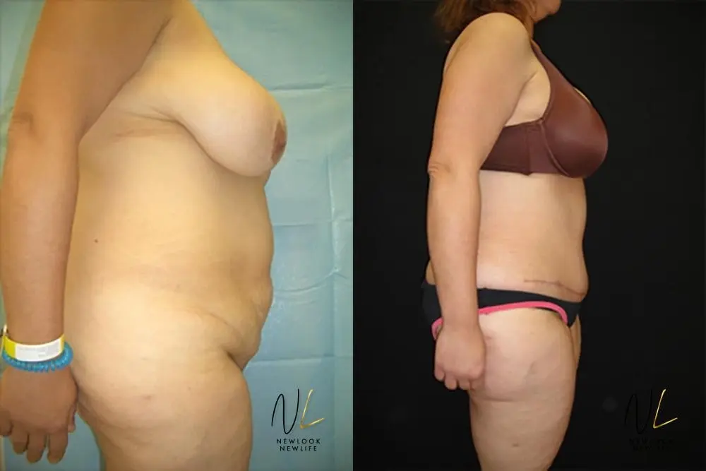 Tummy Tuck: Patient 22 - Before and After 3