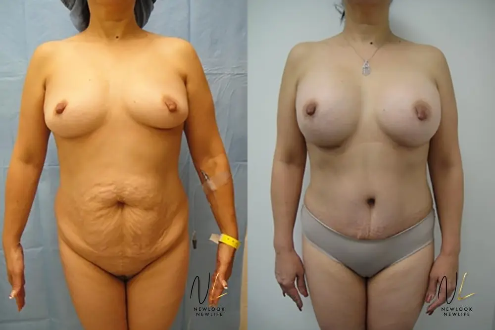 Tummy Tuck: Patient 13 - Before and After 1