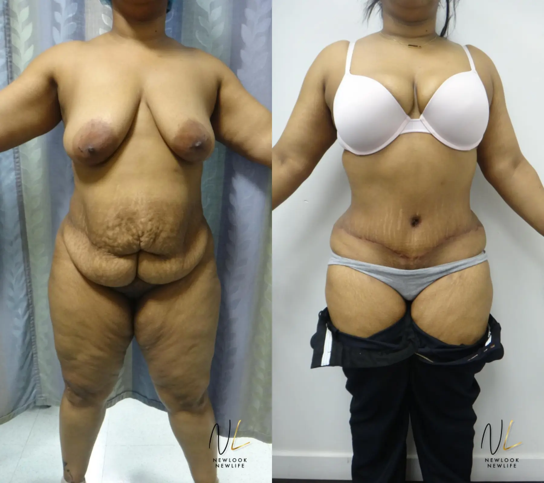 Tummy Tuck: Patient 25 - Before and After 1