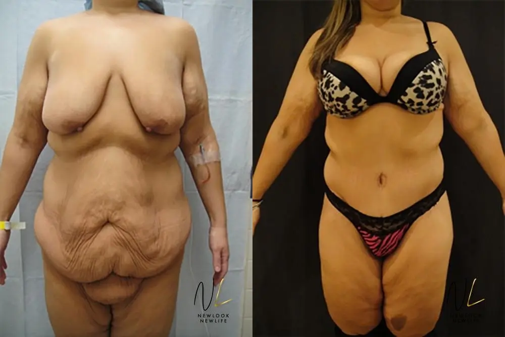 Tummy Tuck: Patient 20 - Before and After 1