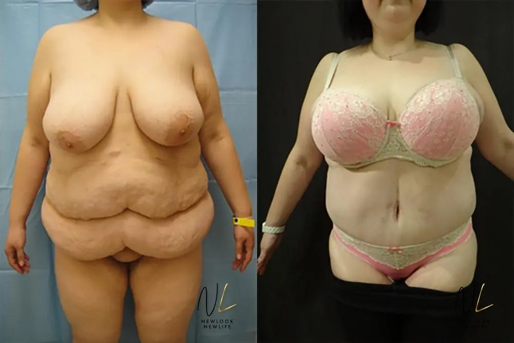 Tummy Tuck: Patient 19 - Before and After 1