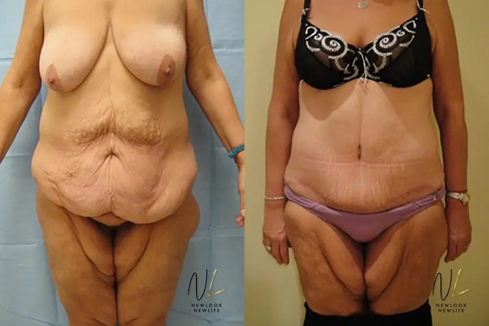 Tummy Tuck: Patient 10 - Before and After  