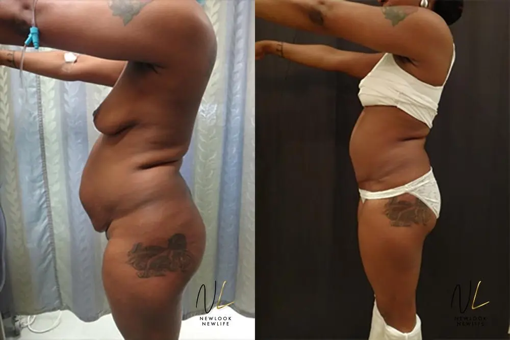 Tummy Tuck: Patient 17 - Before and After 2