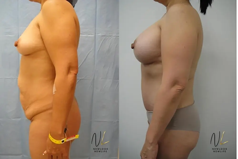 Tummy Tuck: Patient 13 - Before and After 2