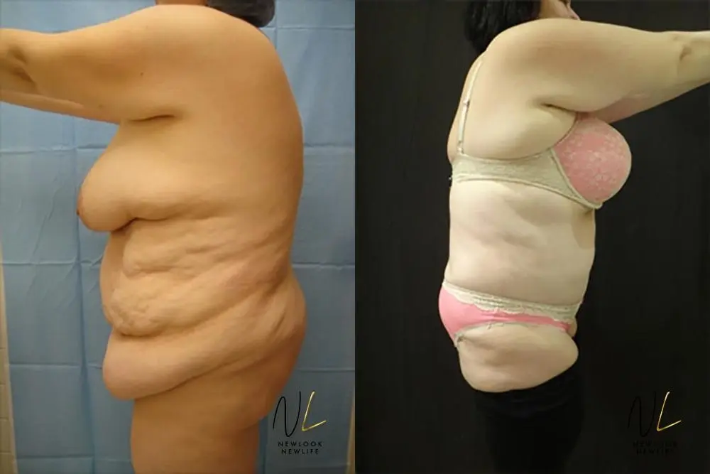 Tummy Tuck: Patient 19 - Before and After 2