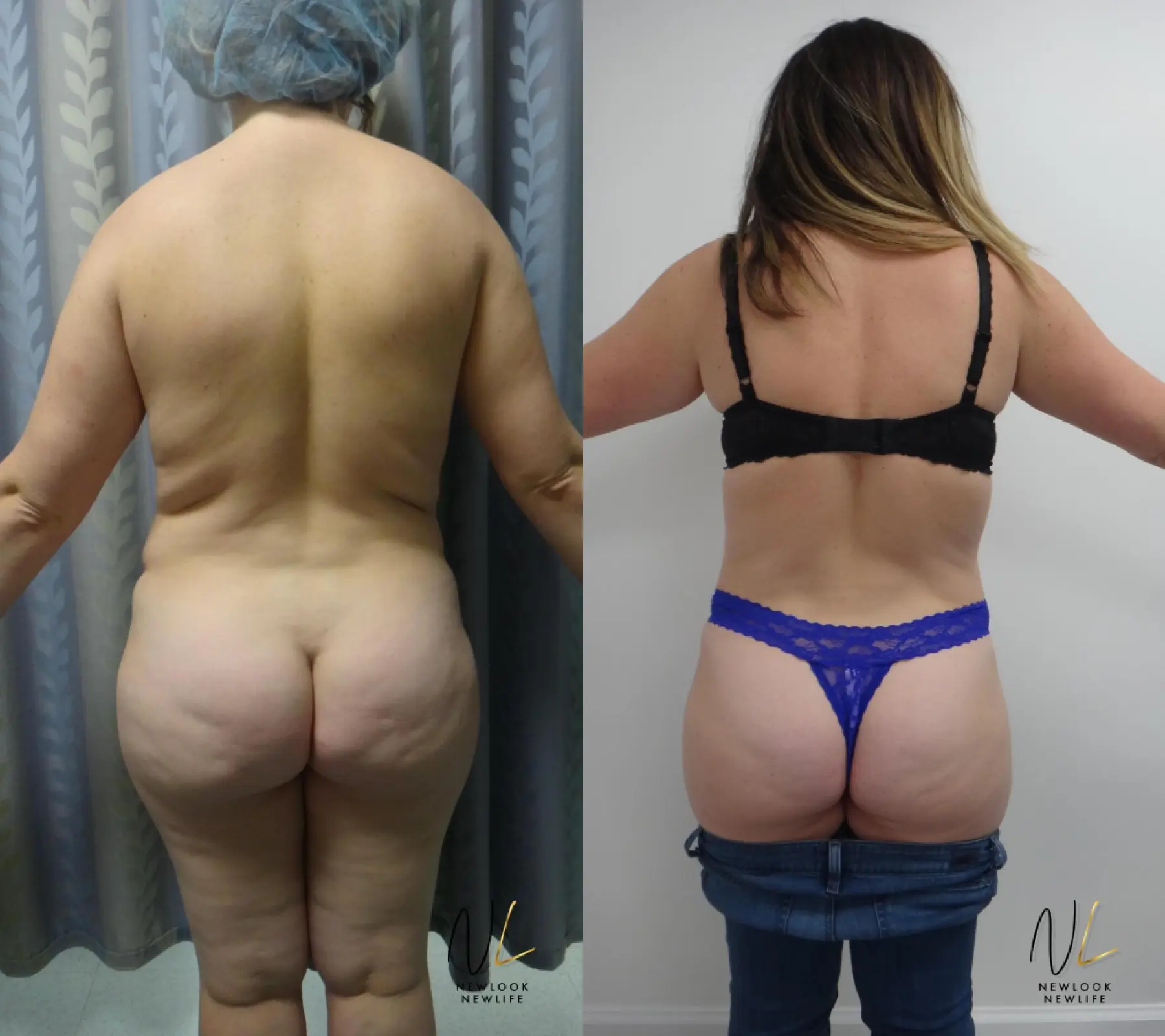 Tummy Tuck: Patient 26 - Before and After 4