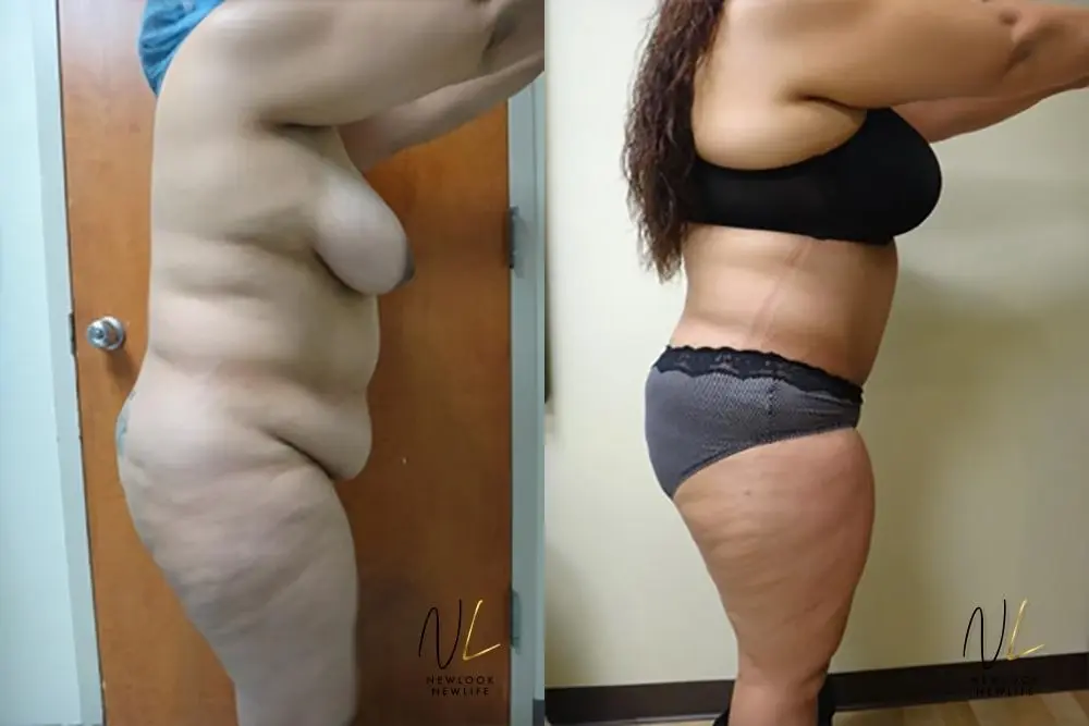 Tummy Tuck: Patient 5 - Before and After 3