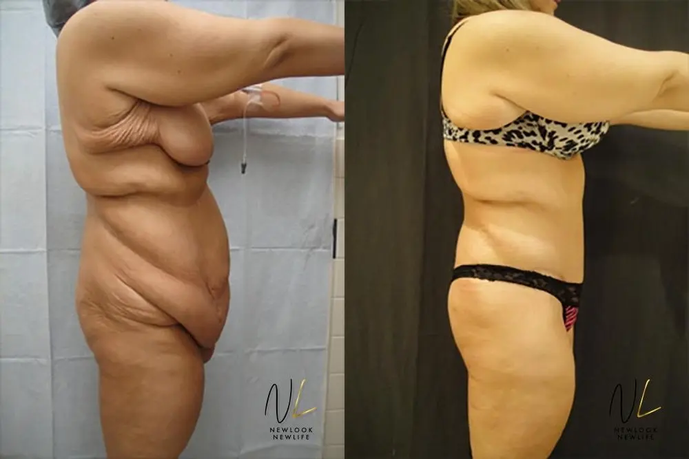 Tummy Tuck: Patient 20 - Before and After 3