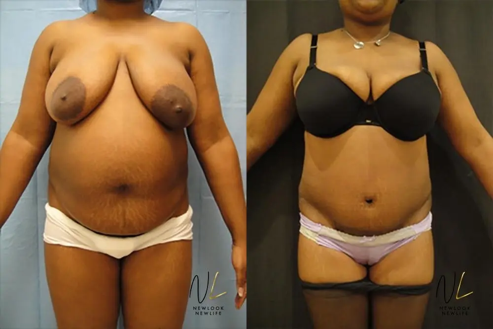 Tummy Tuck: Patient 21 - Before and After 1