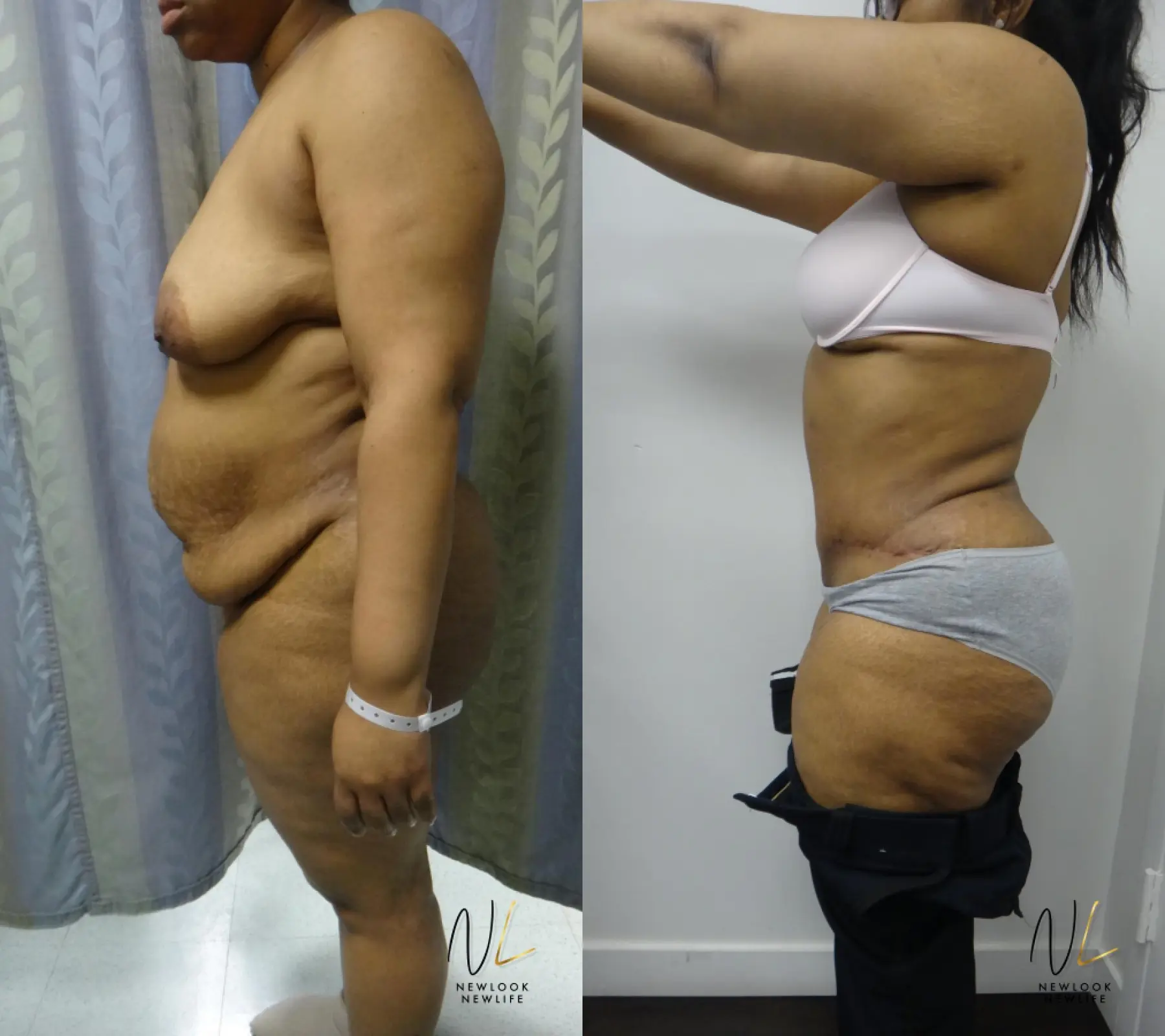 Tummy Tuck: Patient 25 - Before and After 2