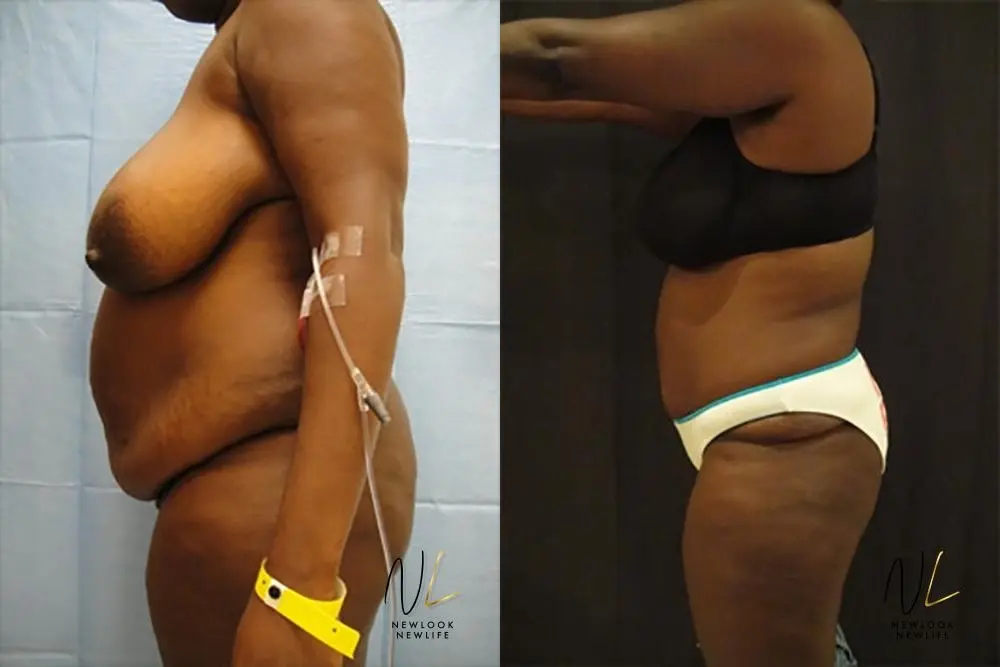 Tummy Tuck: Patient 15 - Before and After 2