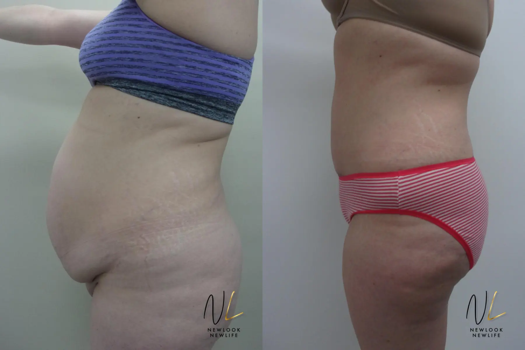 Tummy Tuck: Patient 24 - Before and After 3