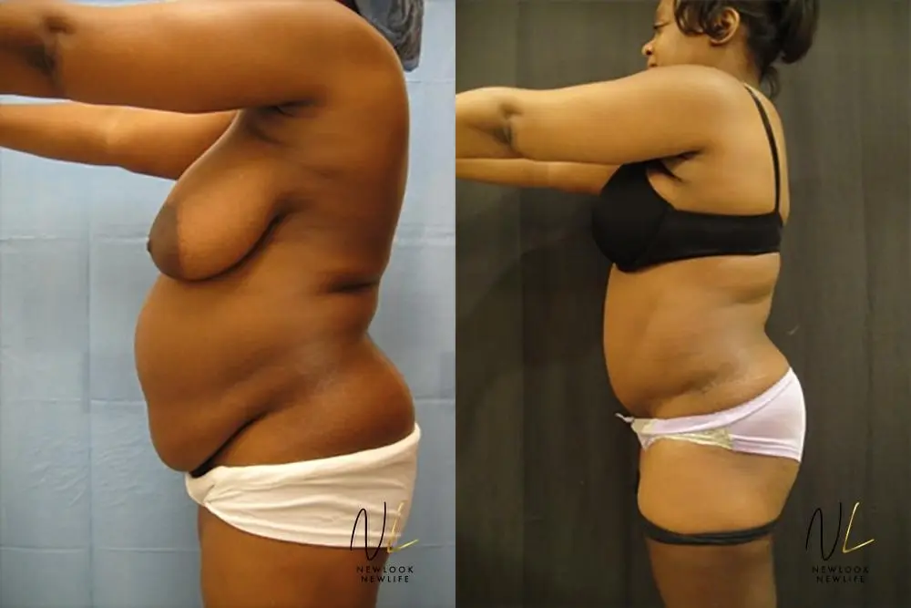 Tummy Tuck: Patient 16 - Before and After 2