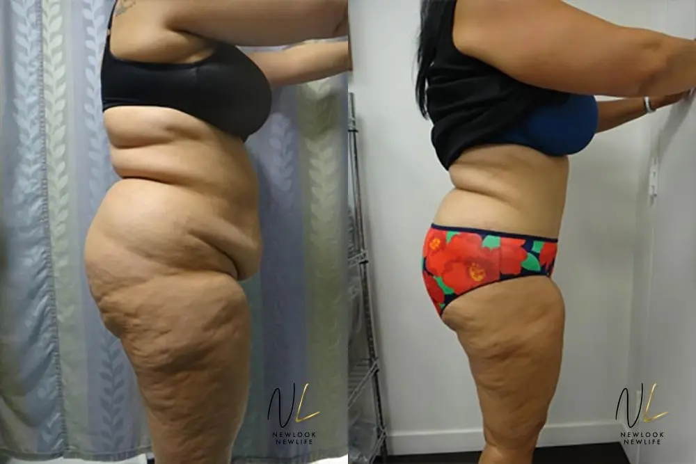 Tummy Tuck: Patient 18 - Before and After 3