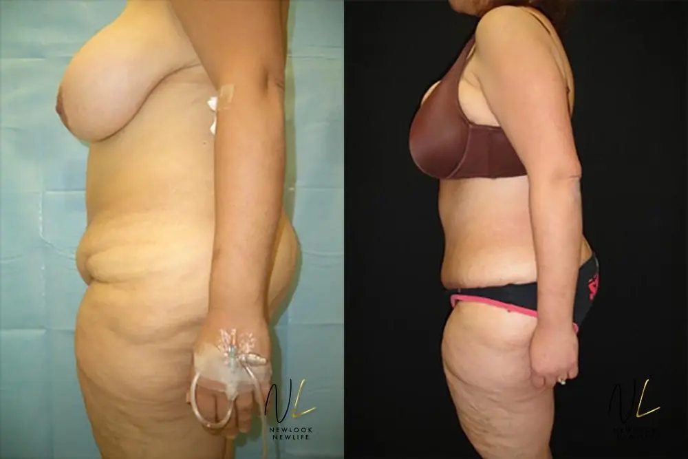 Tummy Tuck: Patient 22 - Before and After 2