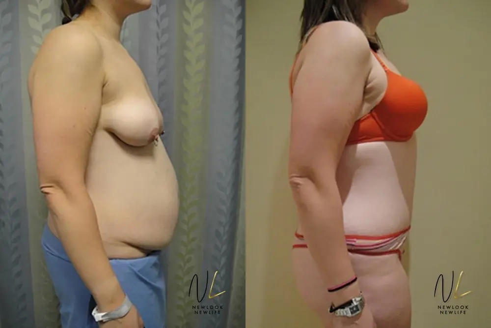 Tummy Tuck: Patient 12 - Before and After 3