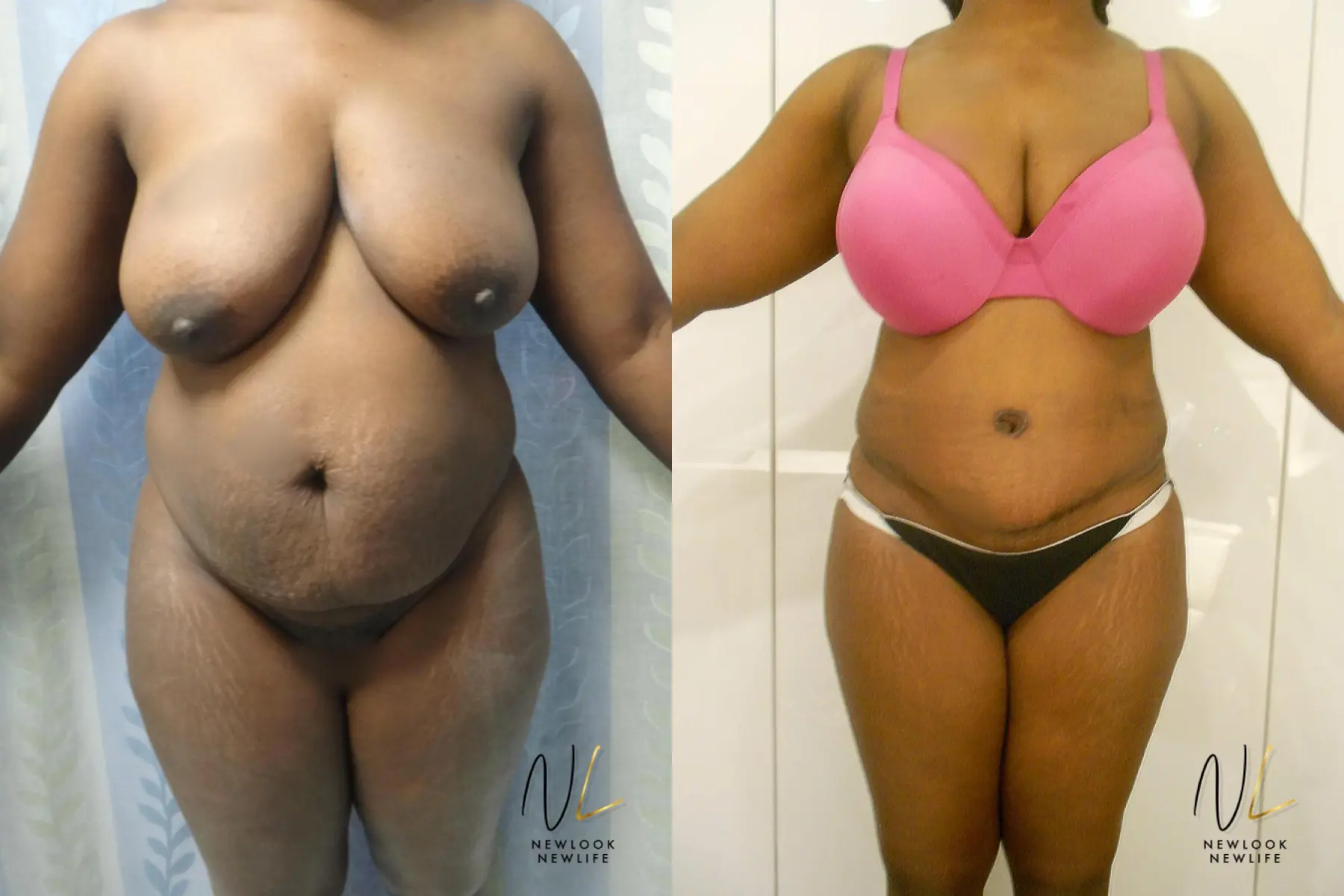 Tummy Tuck: Patient 29 - Before and After 1