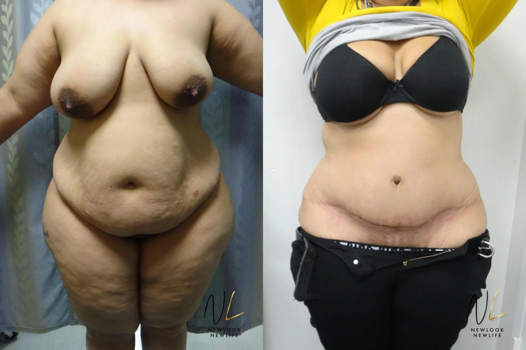 Tummy Tuck: Patient 28 - Before and After 1