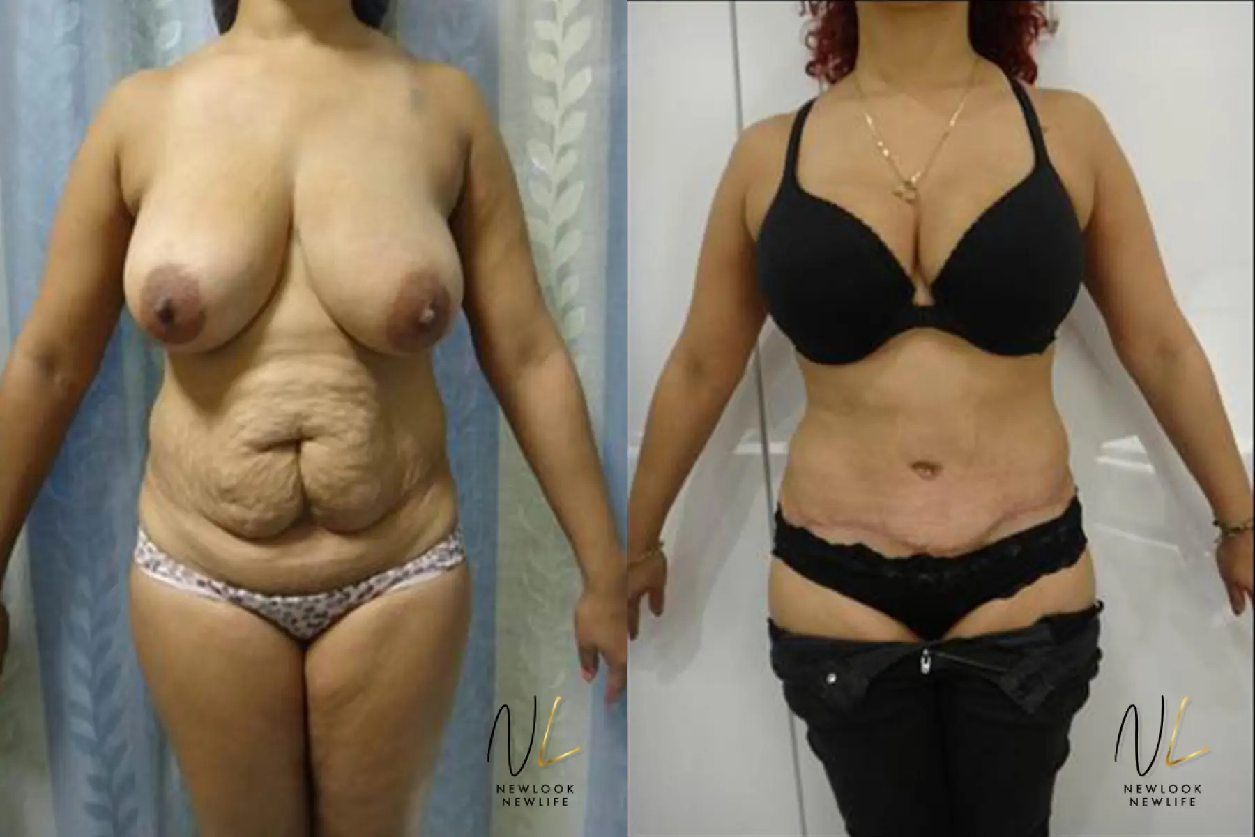 Tummy Tuck: Patient 27 - Before and After 1