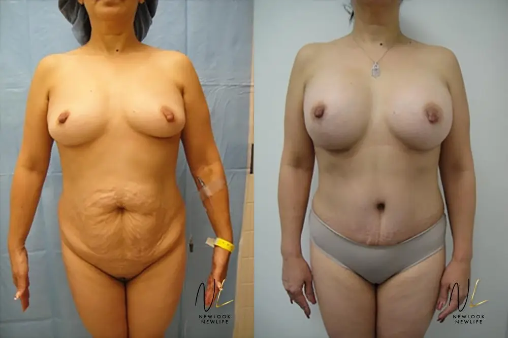 Tummy Tuck: Patient 23 - Before and After 1